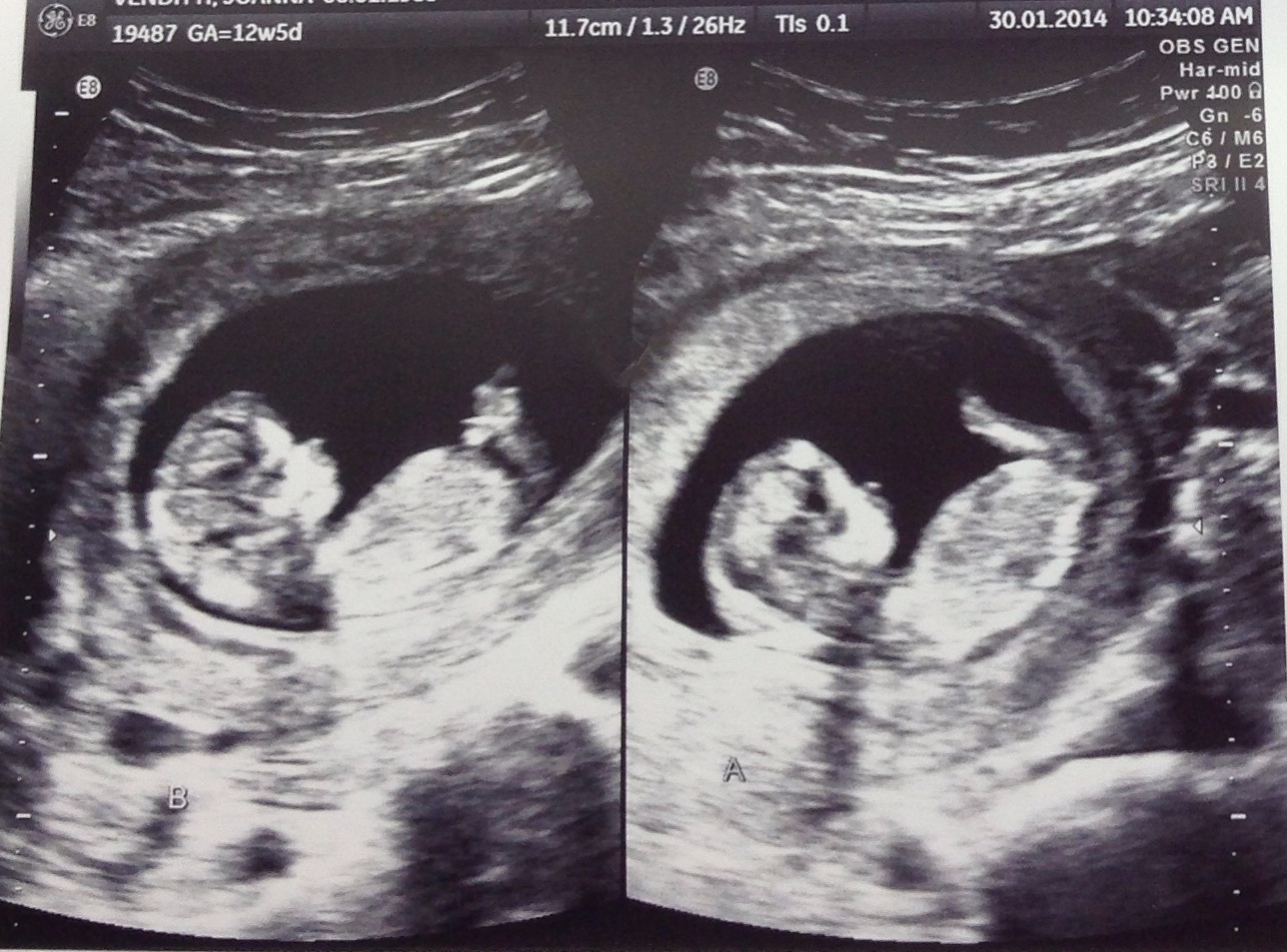 Twins Ultrasound 12 Weeks