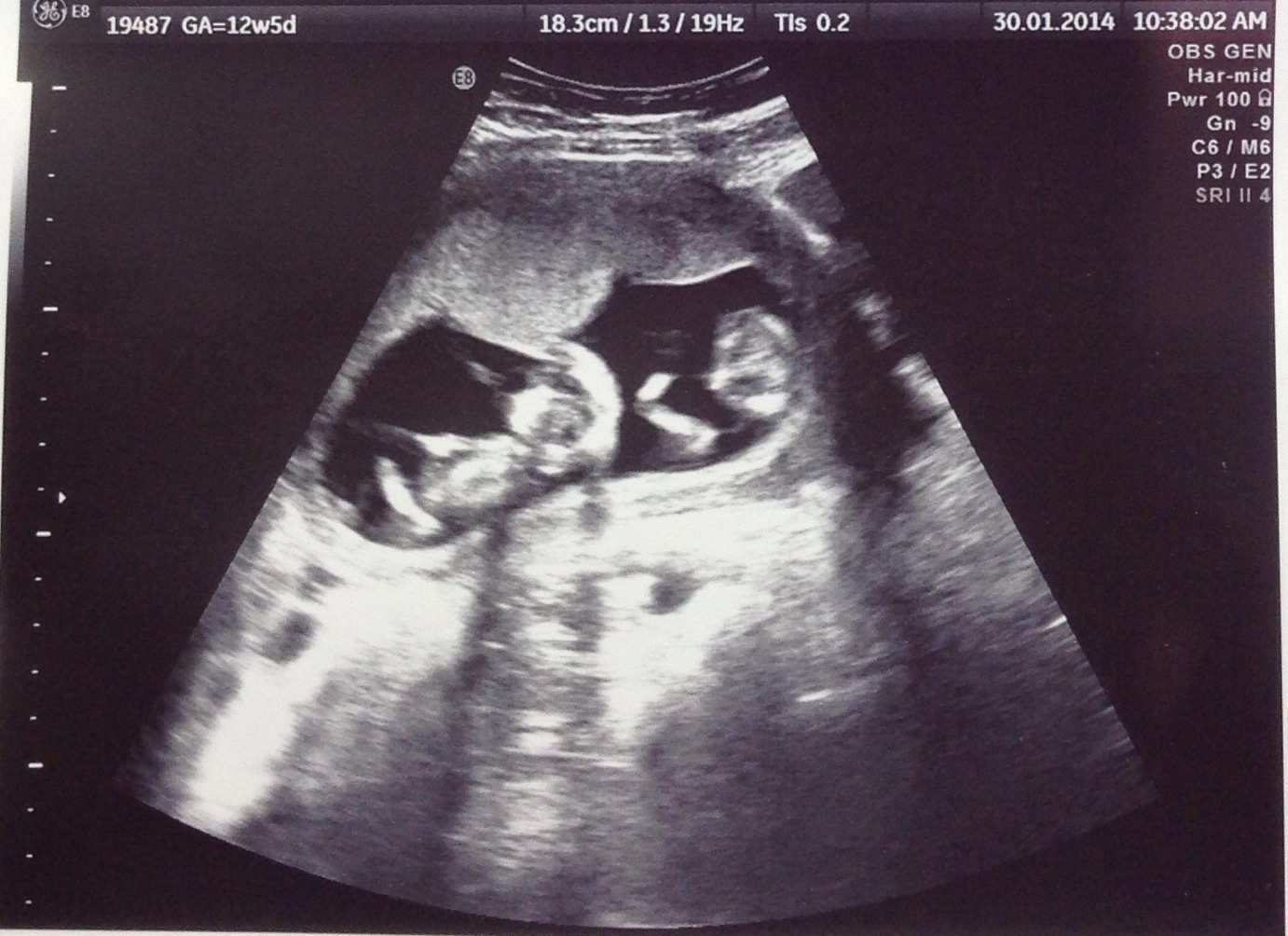 Pictures missed twin ultrasound 11 Weeks