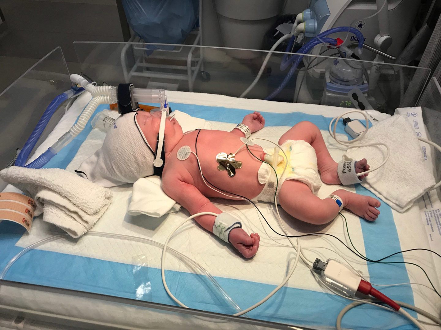 Baby A was a vaginal twin birth
